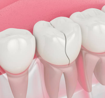 Three white dental crowns on pink gum models against pink background, dental prosthetics display.
