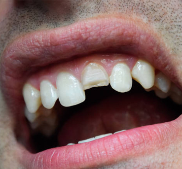 Close-up of open mouth showing upper teeth with visible gaps and discoloration.
