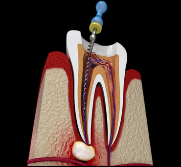 Dental endodontic procedure illustration showing root canal treatment with drill accessing tooth pulp chamber.