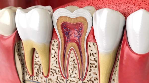 Anatomical cross-section diagram showing tooth structure with pulp, dentin, and surrounding bone tissue.