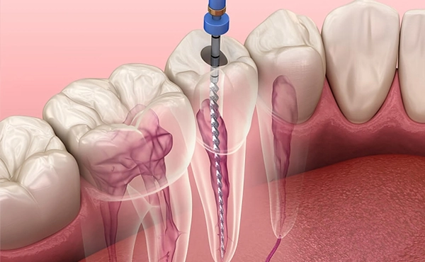 Dental root canal procedure illustration showing endodontic treatment with needle injection into tooth canal.