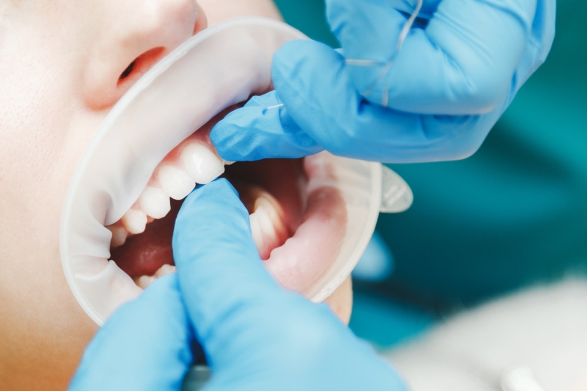 Dentist in blue gloves examining child's teeth during dental checkup.