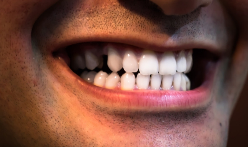 Get Rid of White Stains on Teeth