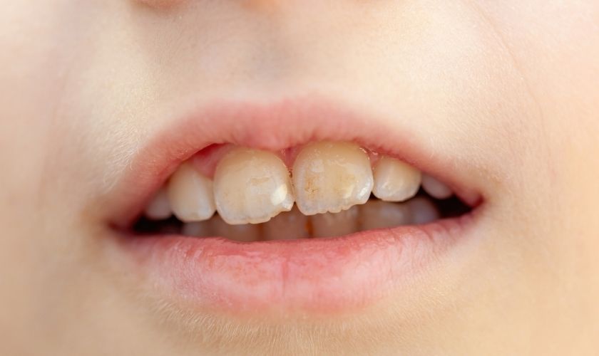White Spots on Teeth Indicate Enamel Loss