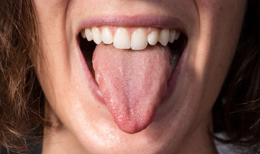 Close-up of a patient's tongue and teeth showing normal appearance after dental work.